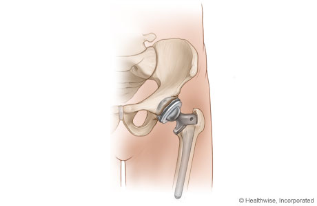 Hip replacement diagram